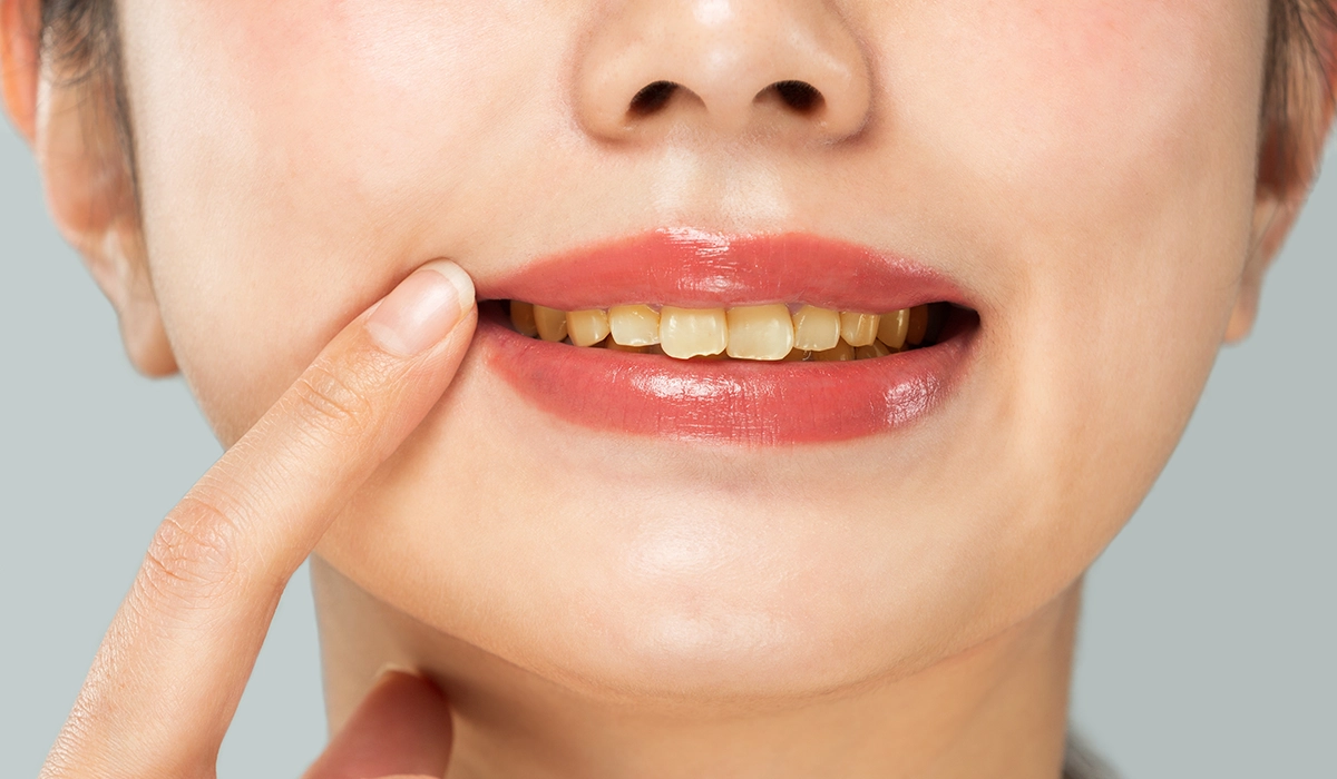 歯の着色汚れはエアフローがより効果的